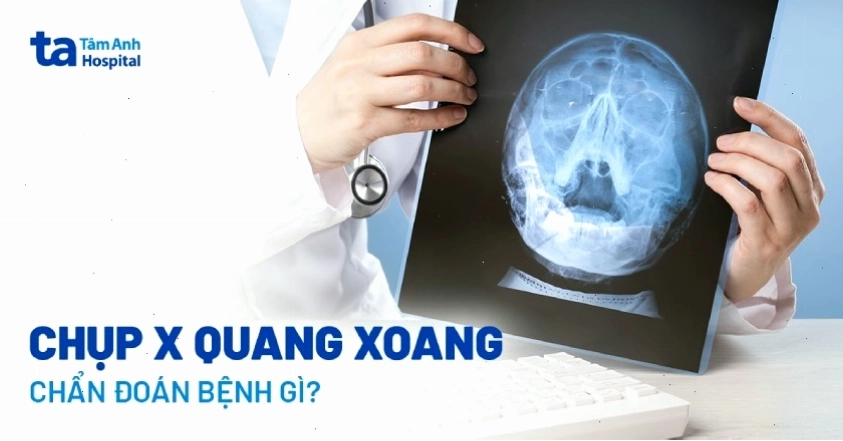 Hình ảnh minh họa chụp X-quang xoang
