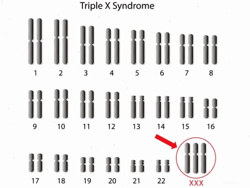 Trẻ mắc hội chứng siêu nữ có 3 nhiễm sắc thể X thay vì 2