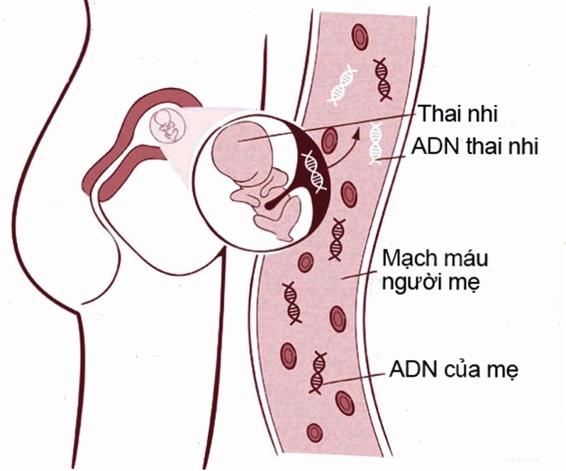 Xét nghiệm NIPT giúp sàng lọc hội chứng siêu nữ